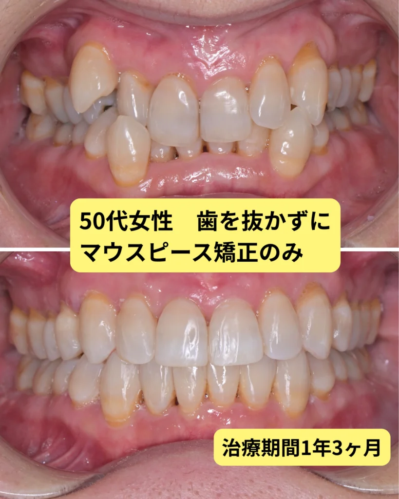 抜歯をできるだけ避けるための選択肢