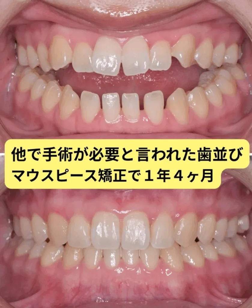 治療前 開咬（オープンバイト）と呼ばれる状態