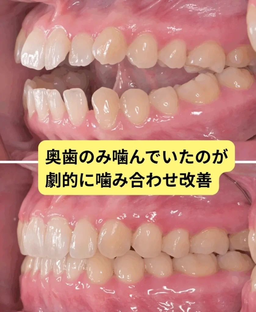 治療後 手術を回避してマウスピース矯正で治療