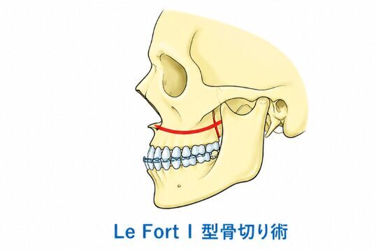 Le Fort I 型骨切り術
