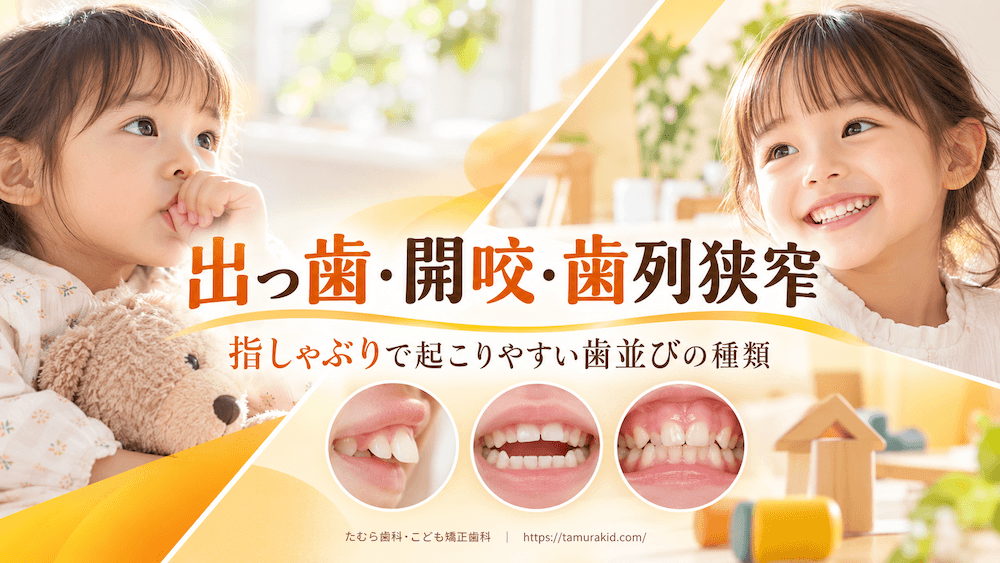 指しゃぶりが原因で生じやすい悪い歯並びの種類